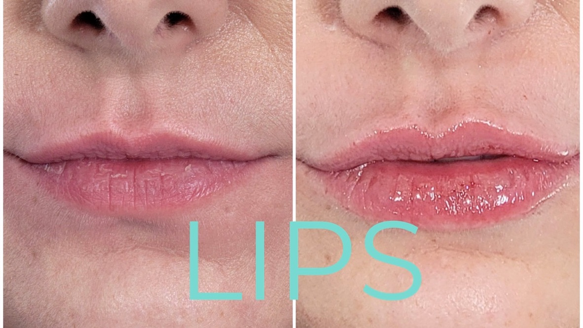 Two side-by-side close-up lip photographs supplied by Dr. Petro, with the word LIPS.